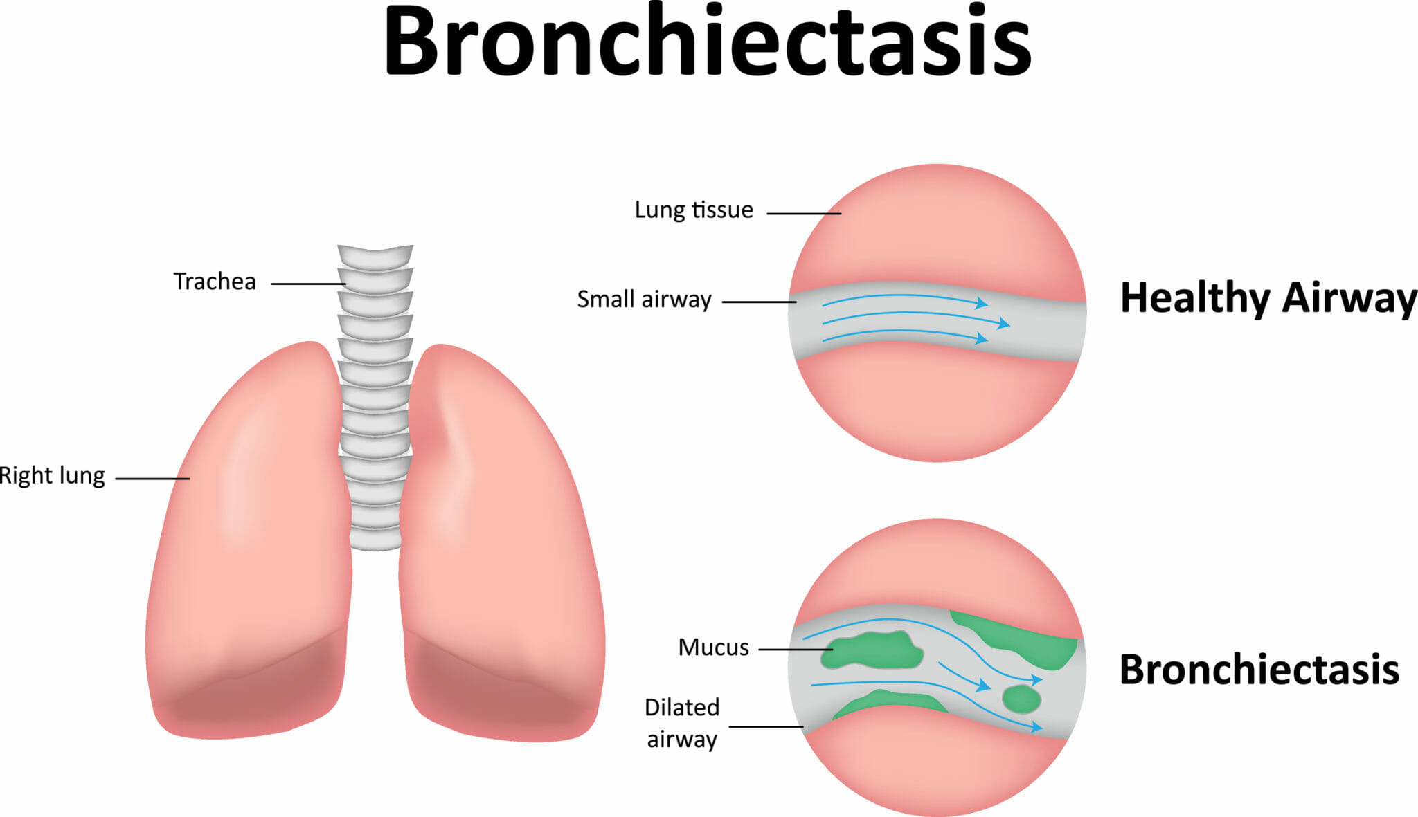 bronchiectasis-bronchiectactis-treatment-london-respiratory-london