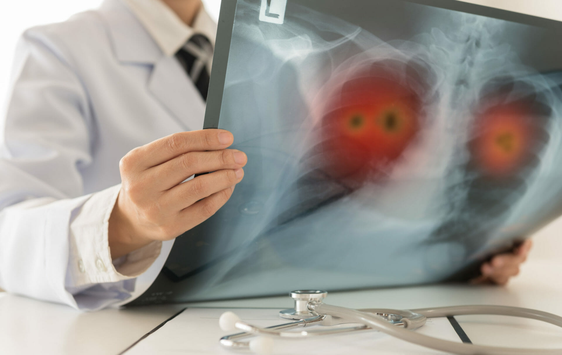 Lung Cancer. Doctor radiology check up xray image have problem lung tumor of patient in clinic room.